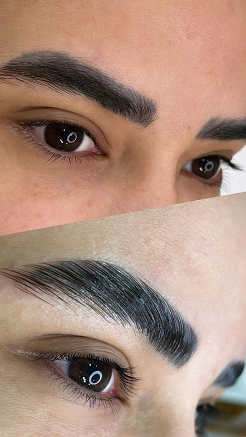 لیفت و بوتاکس ابرو